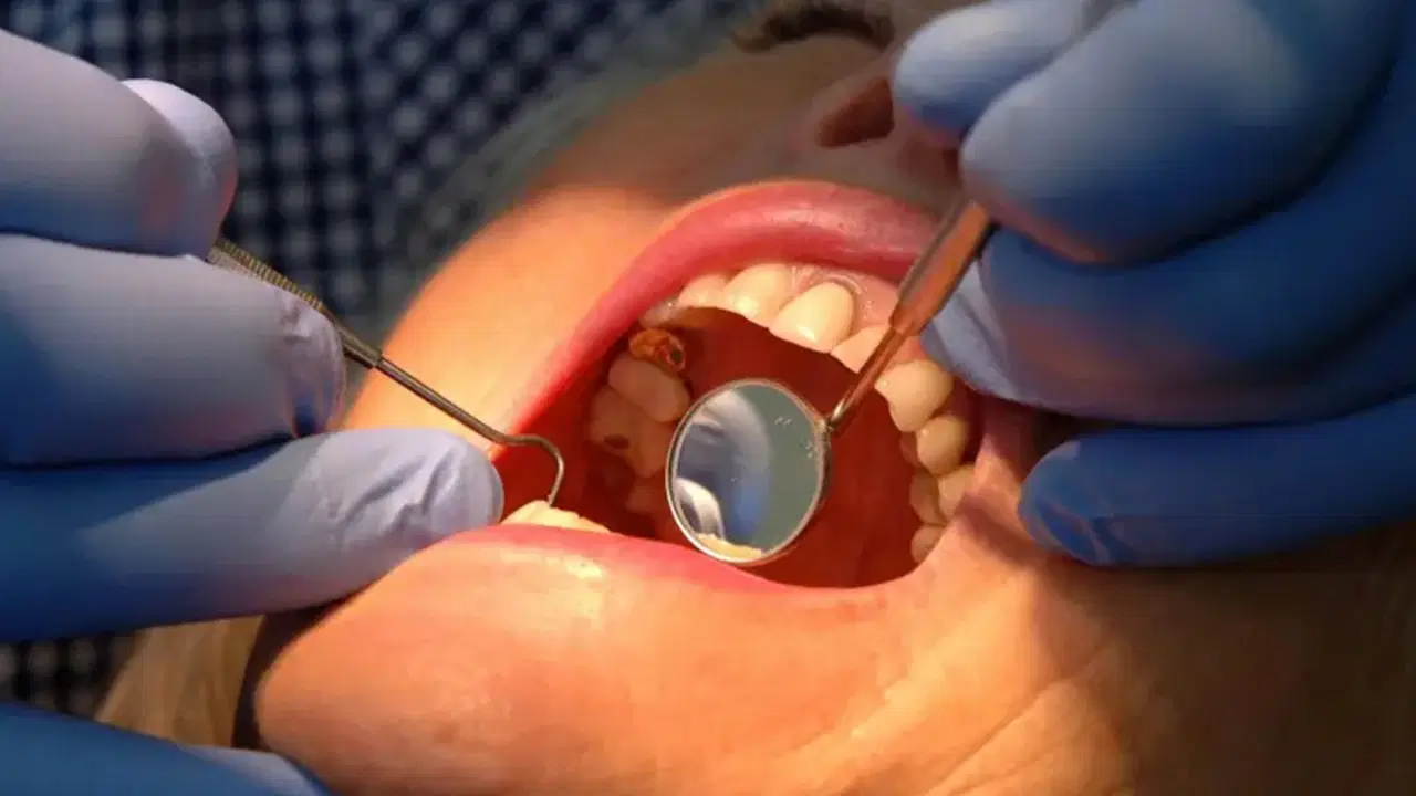 dis minesini onaran yeni jel curuklerin sonu mu geliyor v5B5C79N.jpg