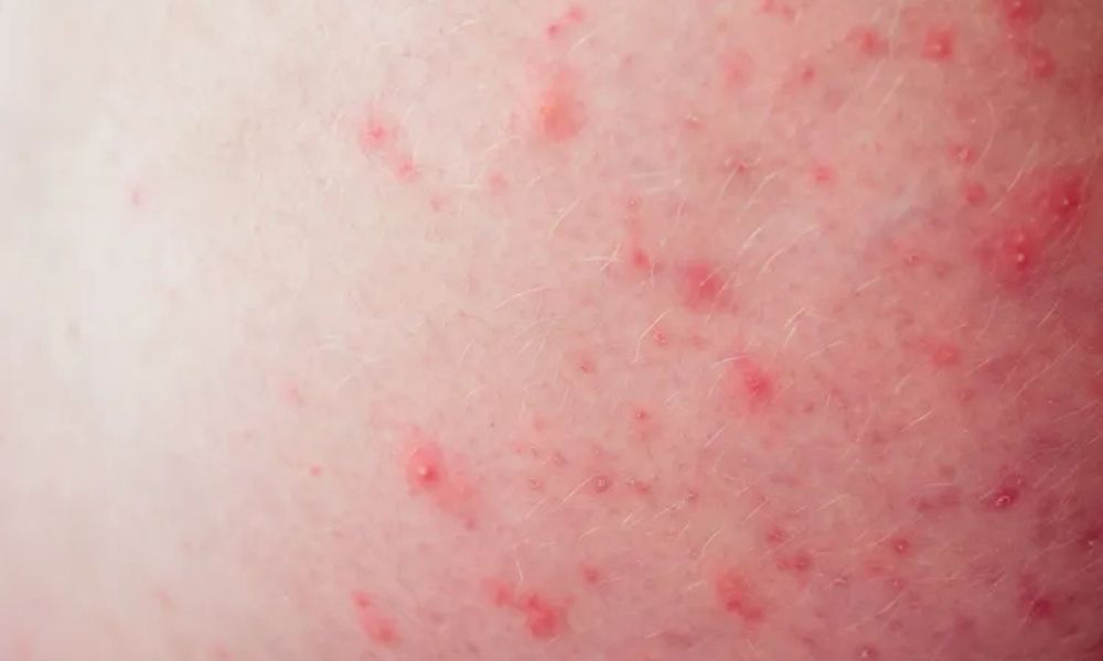 Kalçada Neden Sivilce Çıkar? Nasıl Tedavi Edilir?